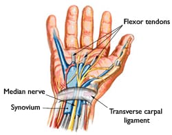 Carpal Tunnel Syndrome in a Maryland Workers Compensation Case